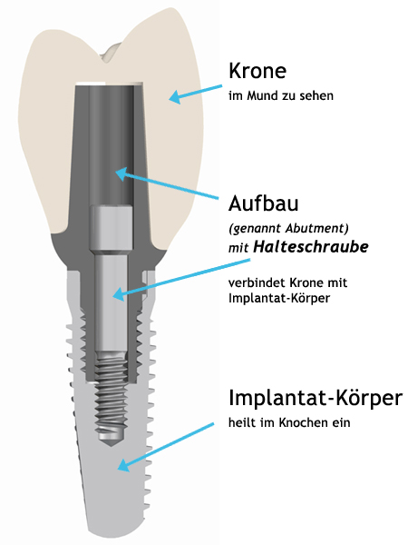 Aufbau Implantat