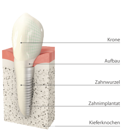 was sind implantate