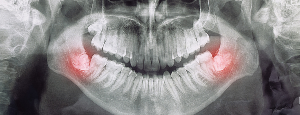 Oralchirurgie Weisheitszähne Zahnarzt Lachen am See